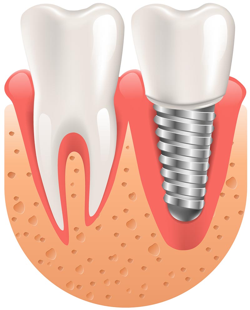 Couronne sur implant Clinique Dentaire Dr Eric Lajoie