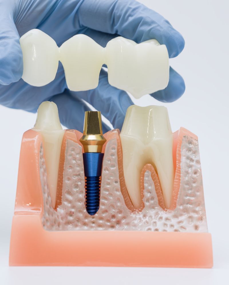 Couronne sur implant dentaire - Implant supported crowns - Clinique dentaire Éric Lajoie
